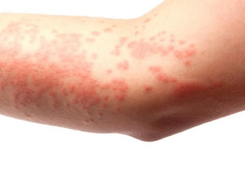 Allergic Reactions: Causes, Symptoms, and Treatments