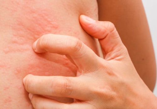 Inhibiting Pro-Allergic Pathways in the Body